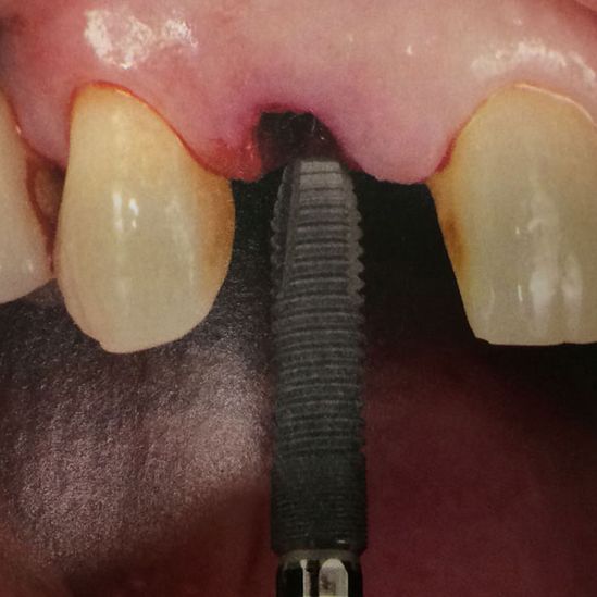 Clínica Dental Reyes Flamarique implantes dentales