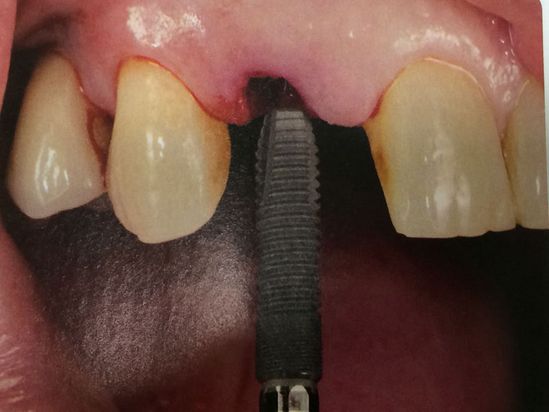 Clínica Dental Reyes Flamarique implantes dentales