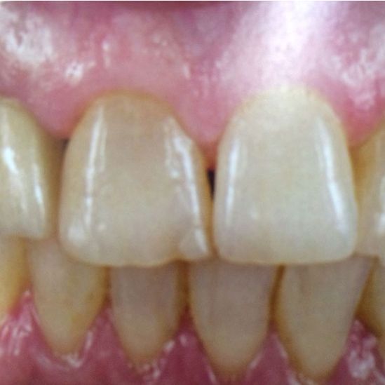 Clínica Dental Reyes Flamarique dientes implantados