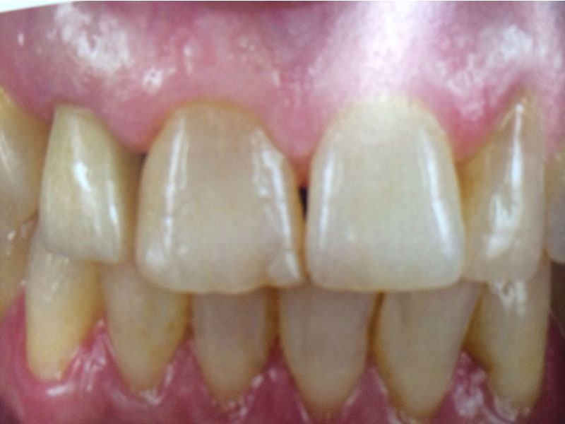 Clínica Dental Reyes Flamarique dientes implantados
