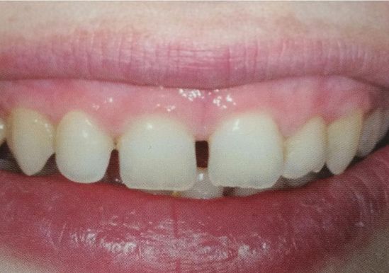 Clínica Dental Reyes Flamarique dentadura de una persona 