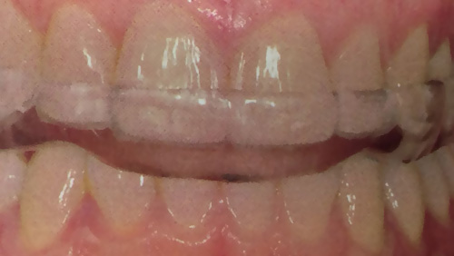Clínica Dental Reyes Flamarique protector para dientes