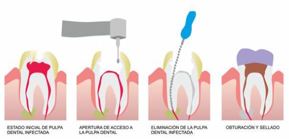 Clínica Dental Reyes Flamarique esquema dental endodoncia